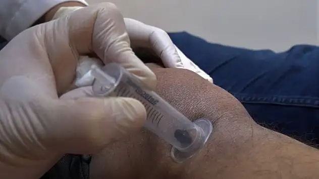 (ÖZEL) Doktor sülükler şifa kaynağı