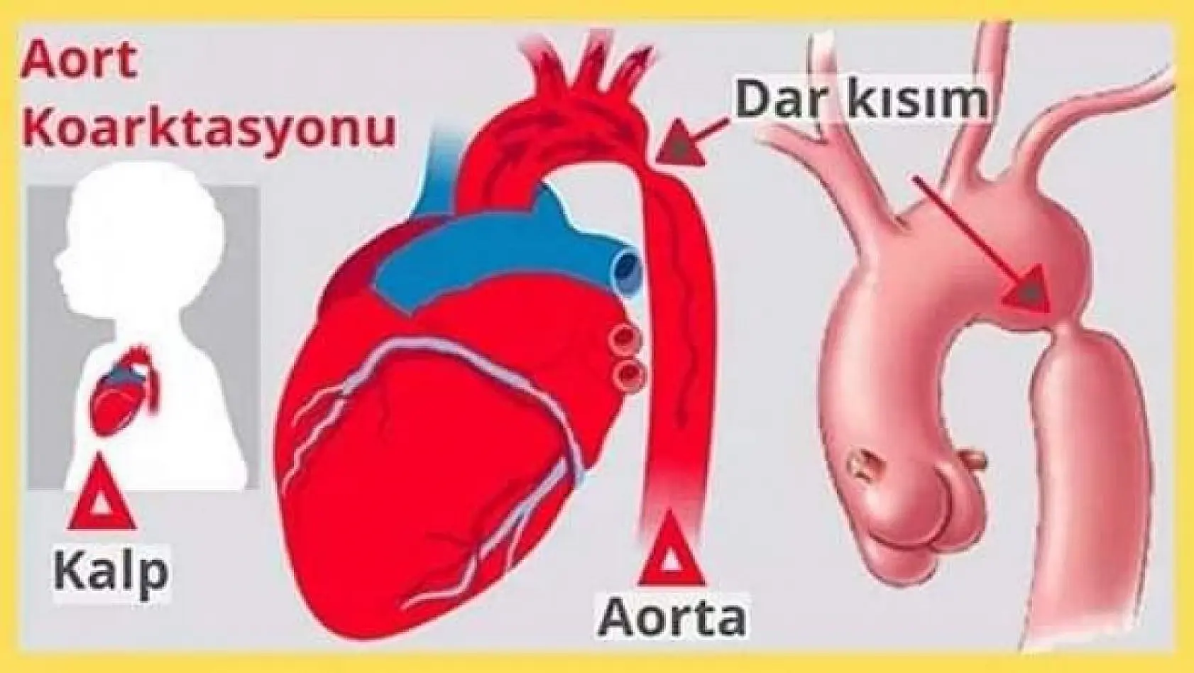Bandırma'da ilk kez aort koarktasyon ameliyatı yapıldı