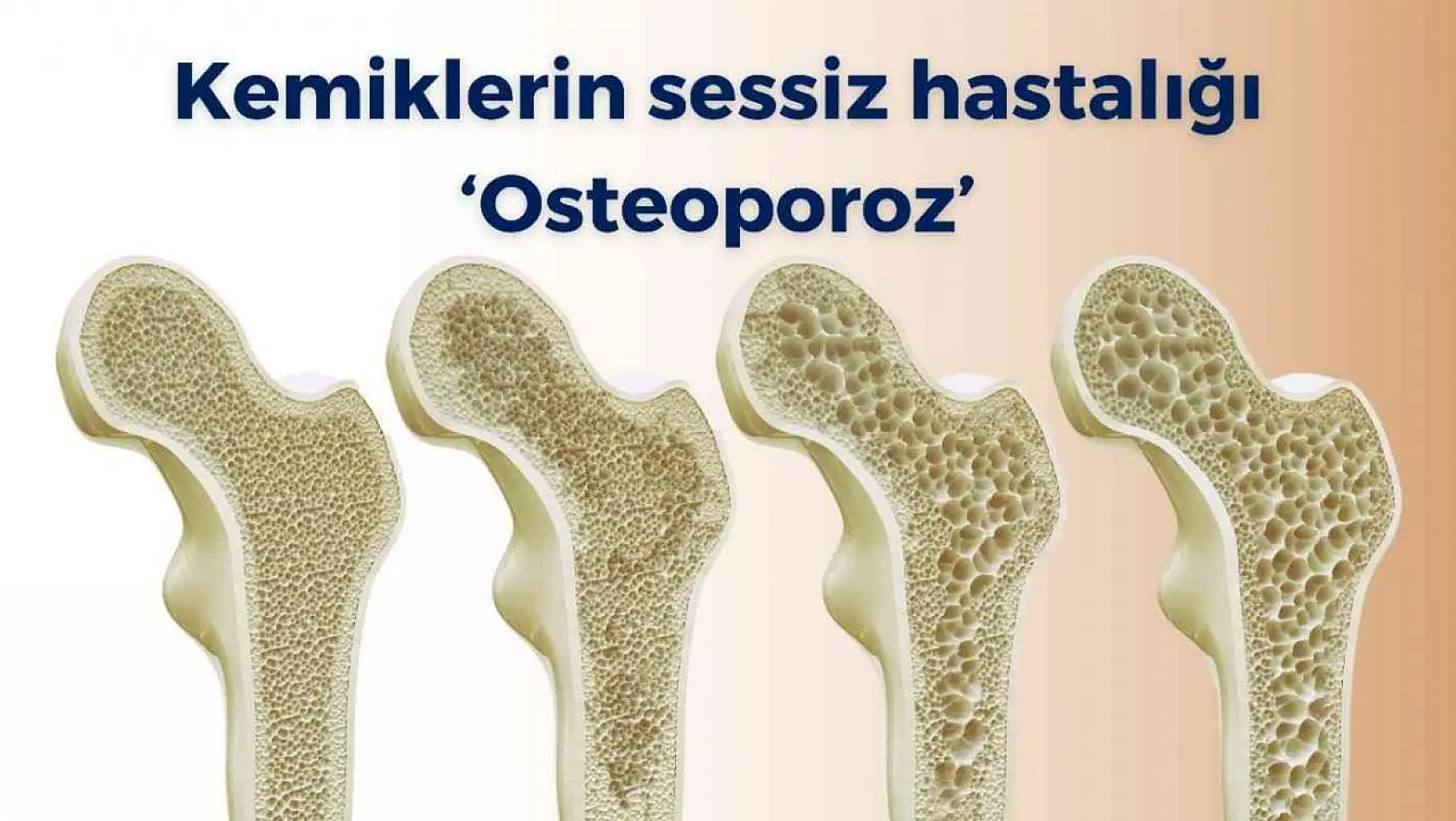 Kemiklerin sessiz hastalığı 'osteoporoz'